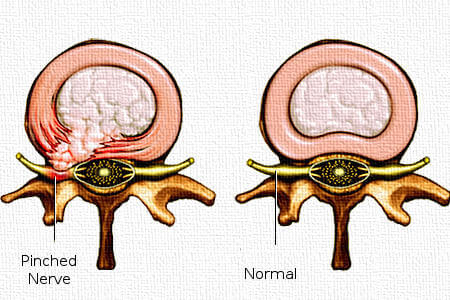 Info-Disc-Injury-My-Auto-Accident-450x300